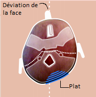 Plagiocéphalie - Sellem Ostéo - Ostéopathe Paris 3