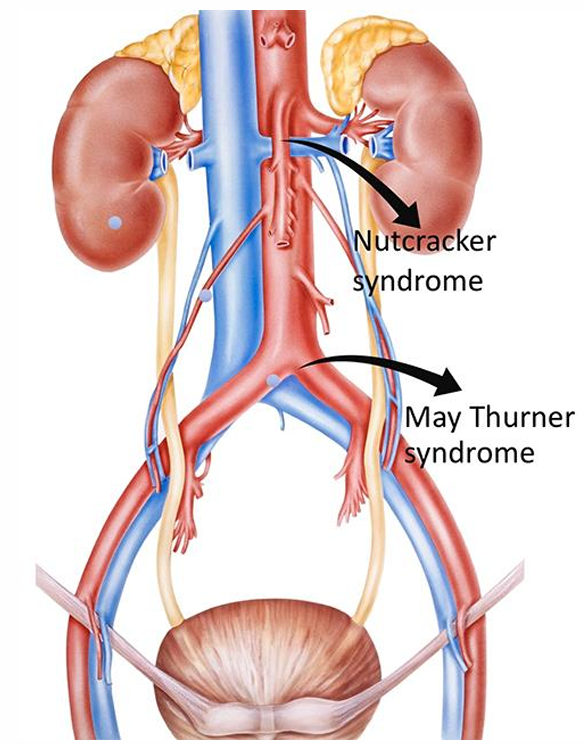 Syndrome de congestion pelvienne - Causes - Ostéopathe Paris - Sellem Osteo