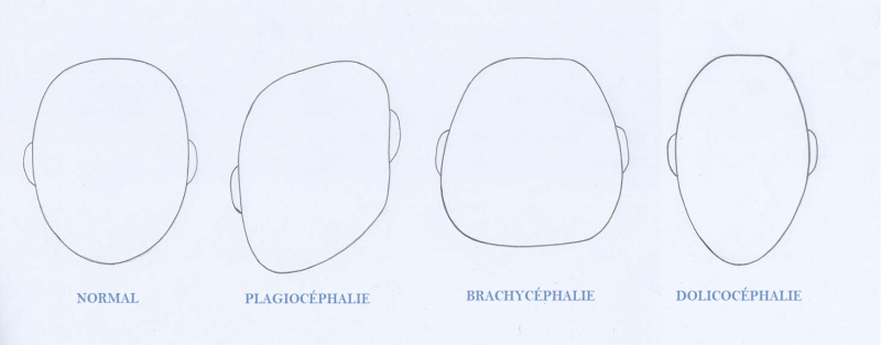Déformations Crâniennes - Sellem Ostéo - Ostéopathe Paris 3