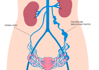 Syndrome de congestion pelvienne et ostéopathie - Ostéopathe Paris 3 - Sellem Ostéo