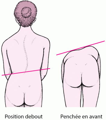 scoliose traitement - diagnostic de la scoliose - Ostéopathe Paris 3 - Sellem Ostéo